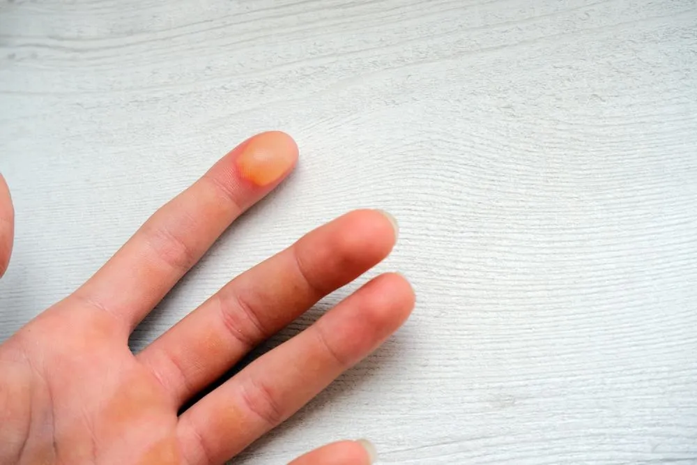 vết bỏng bị phỏng nước phải làm sao nhanh lành