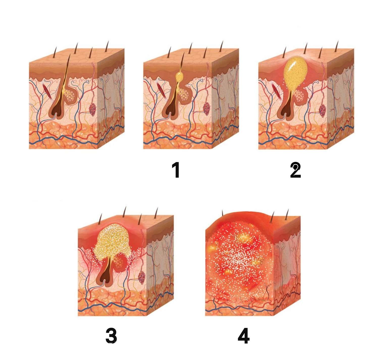 Mụn bọc ở cằm phát triển thế nào