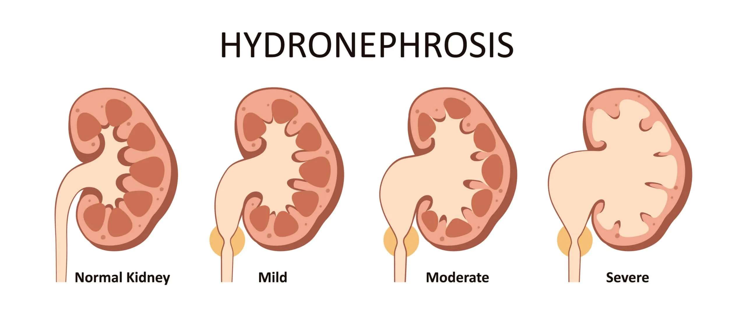 thận ứ nước độ 2