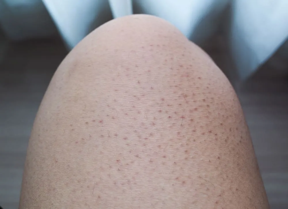 Da bị nổi sần như da gà và ngứa là biểu hiện bệnh gì