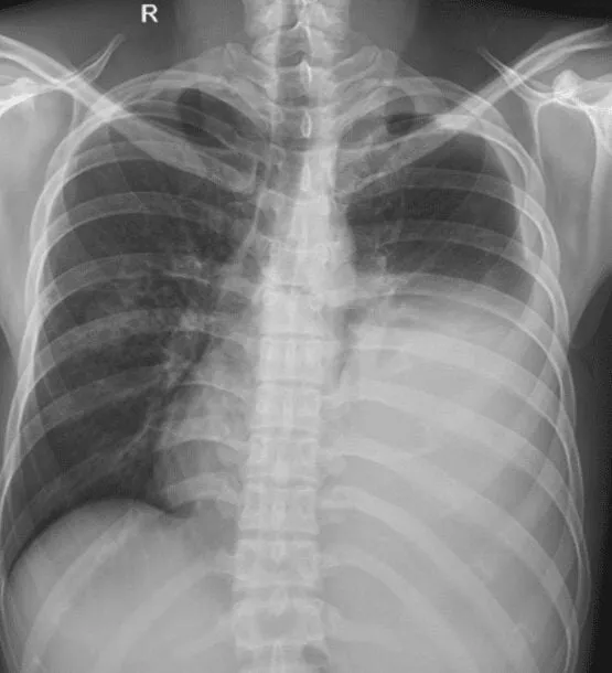 Hình ảnh phổi bị trắng