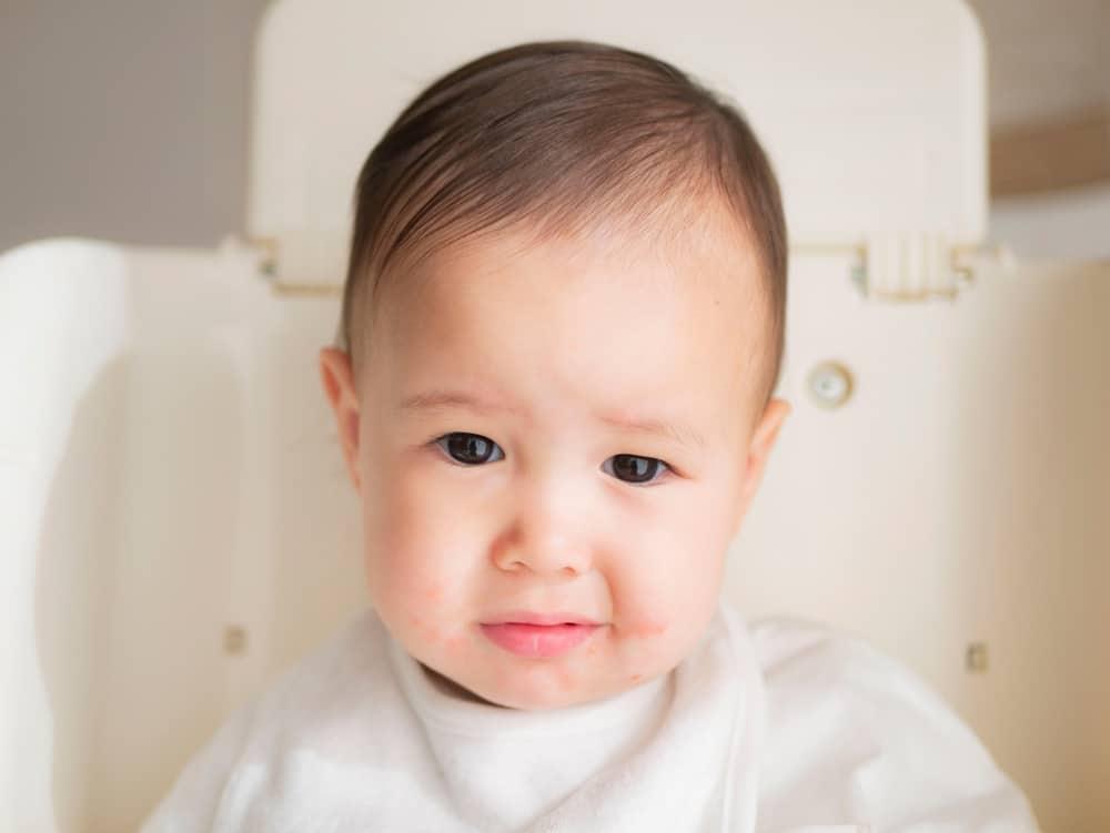 trẻ bị tay chân miệng bao lâu thì khỏi