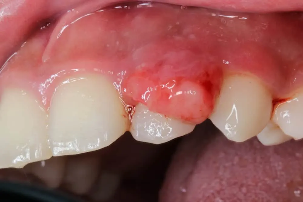 triệu chứng ung thư nướu răng