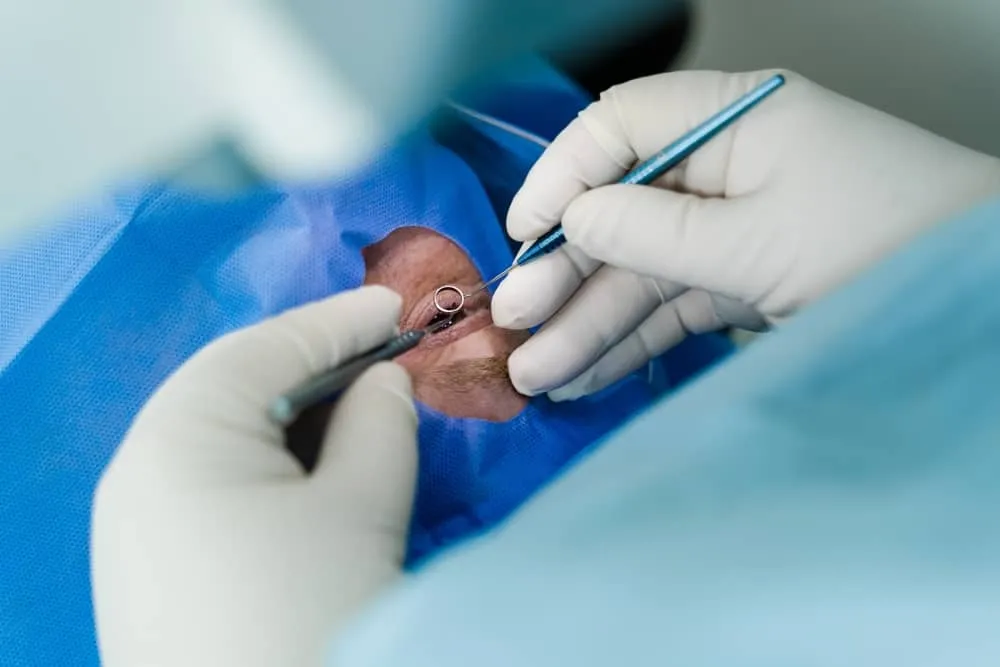 mổ bong võng mạc bao lâu thì khỏi tùy vào vị trí bong ra