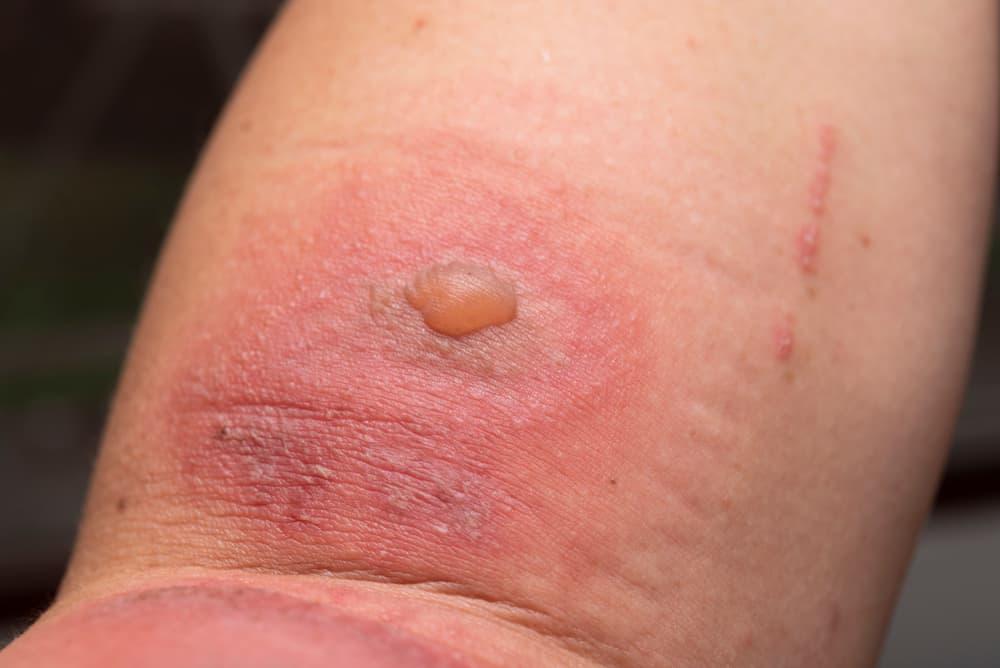 Cách diệt kiến ba khoang