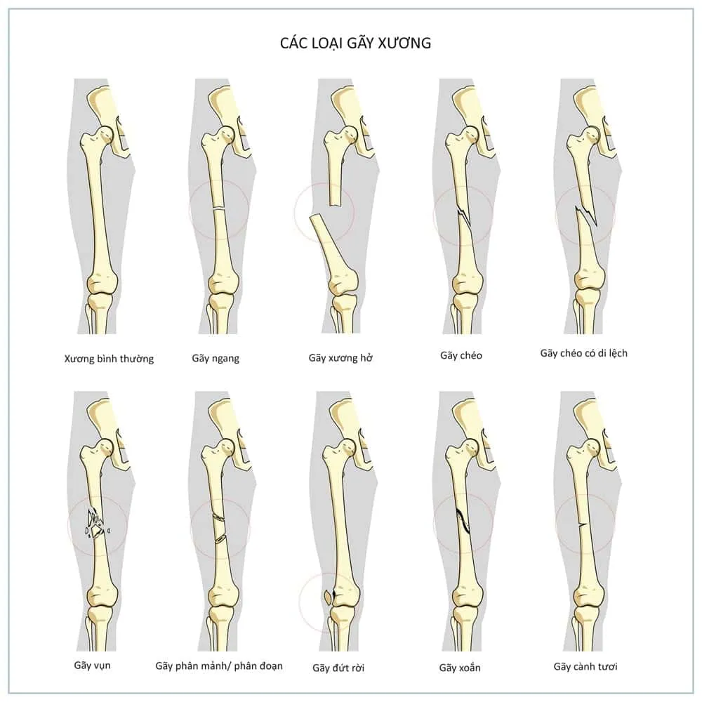 dấu hiệu chắc chắn gãy xương