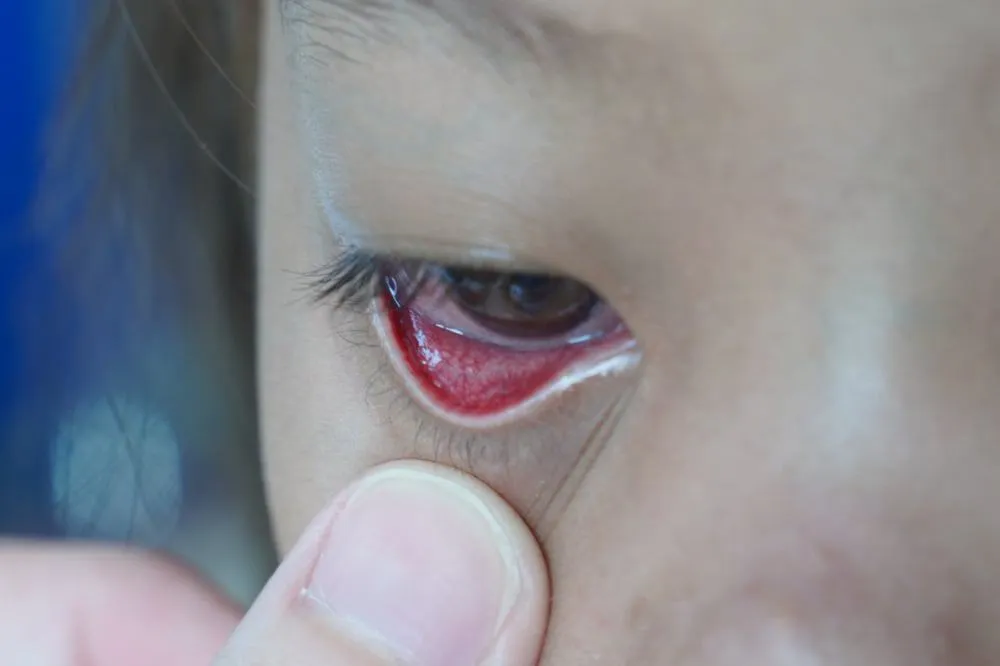 dấu hiệu của tứ chứng fallot