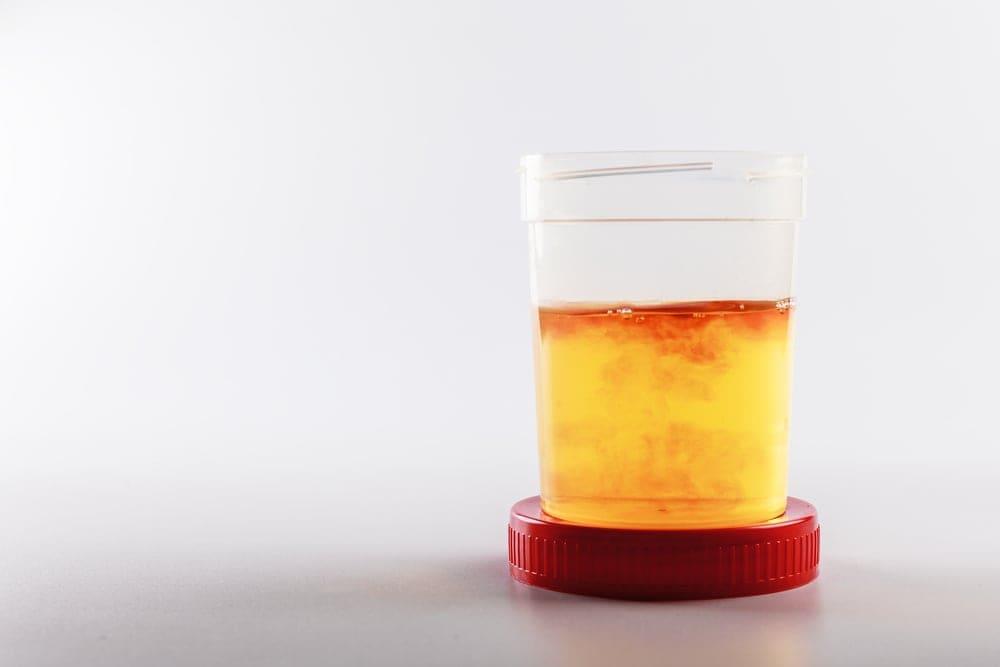 Tiểu rắt buốt ra máu ở nữ