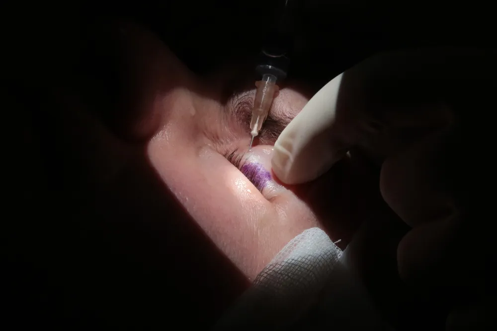 cách chăm sóc mắt sau khi chích lẹo ngừa tái phát