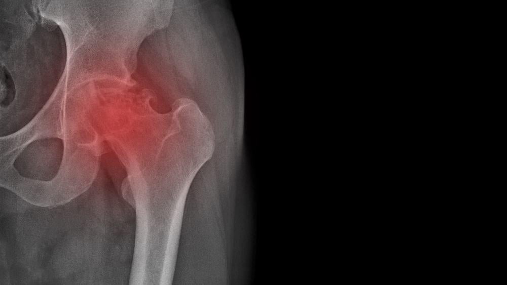 đau khớp háng bên trái