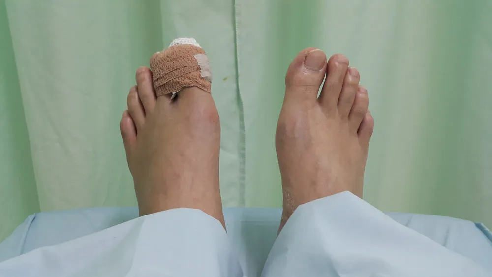 gãy xương không bó bột có sao không