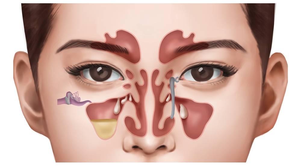 Polyp mũi có tự hết không