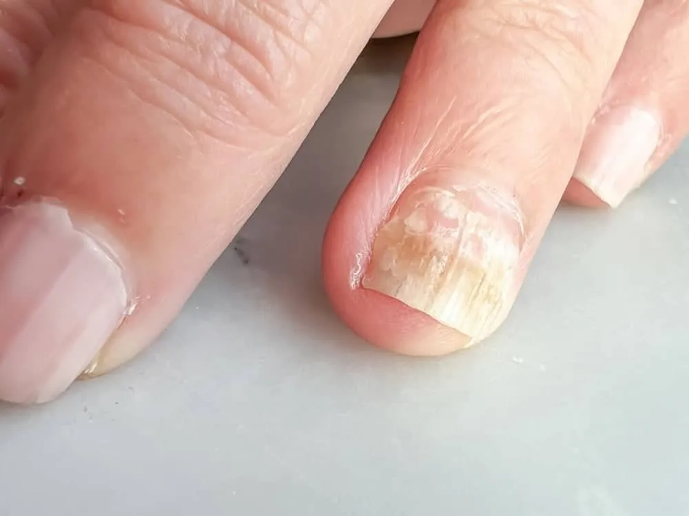 nấm móng tay