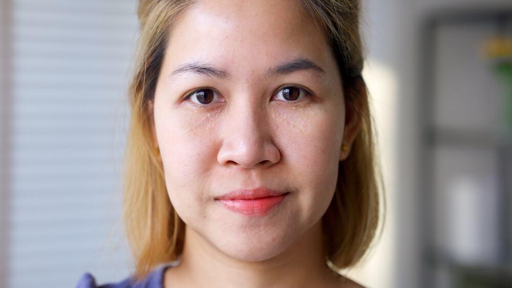 cách trị mụn thịt trên mặt