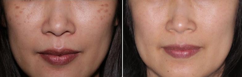 Hình ảnh trước và sau khi điều trị nám chân sâu