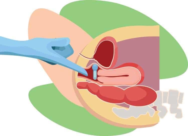 sa tử cung có chữa được không