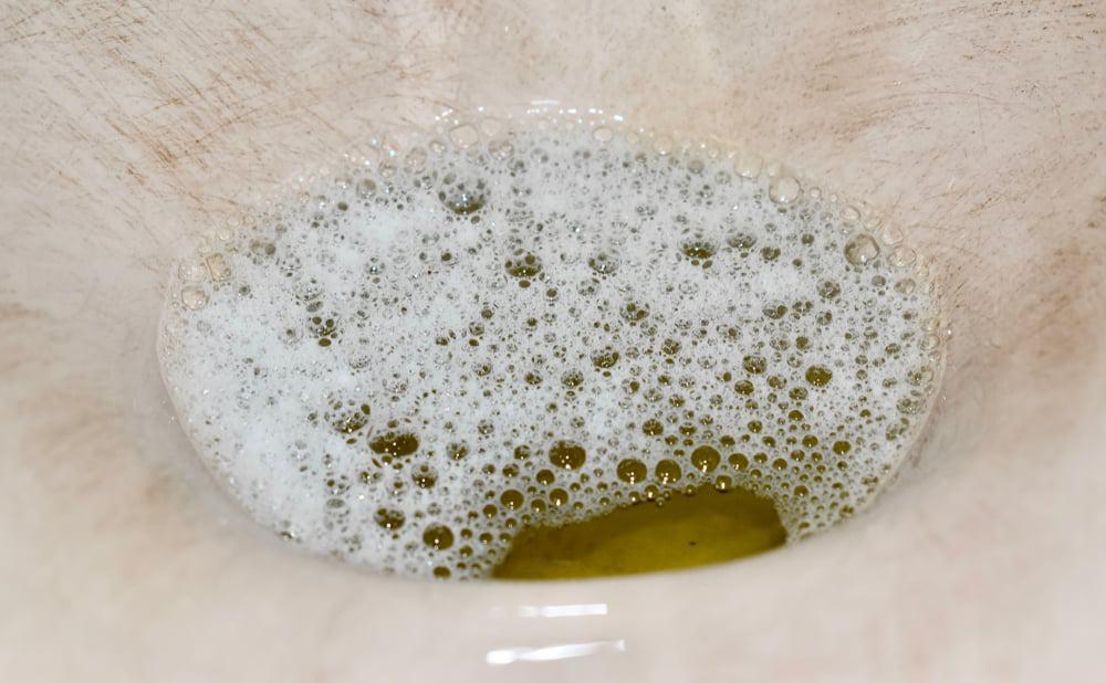 triệu chứng bệnh thận đái tháo đường