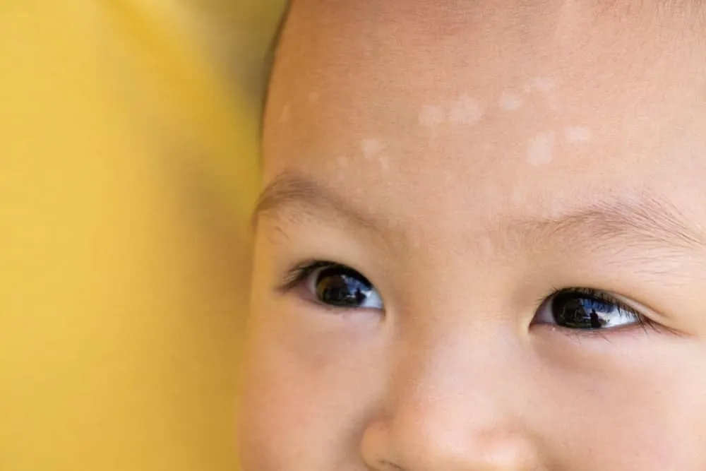 nấm da - lang ben là một trong các bệnh về da ở trẻ em