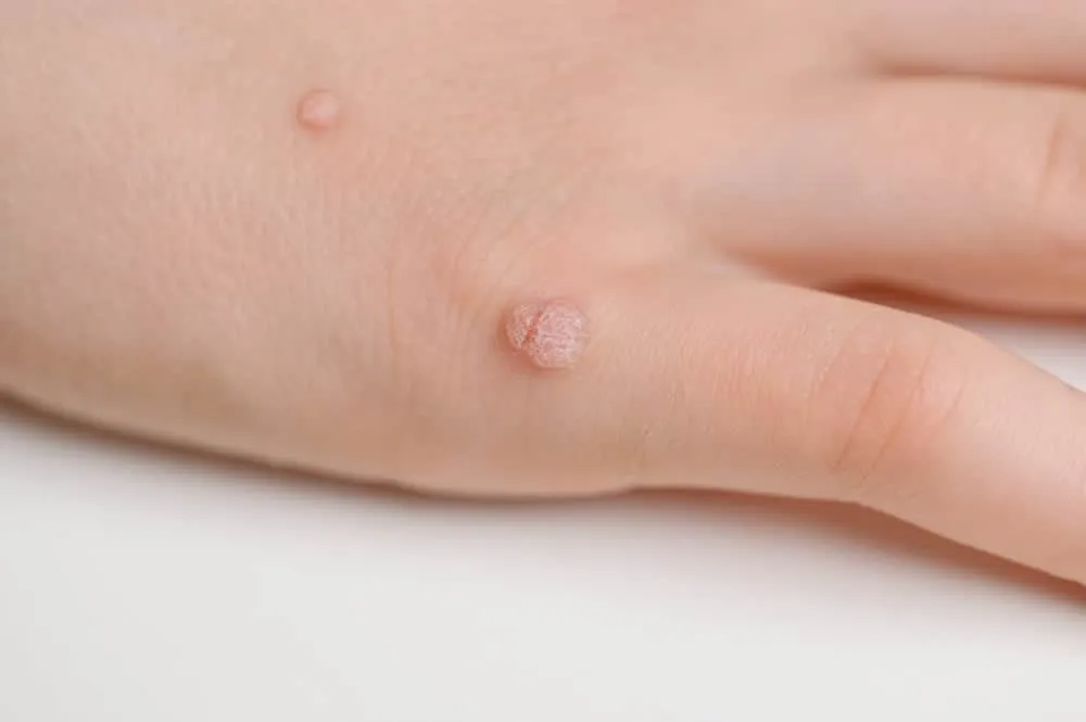 bệnh mụn cóc - một trong các bệnh về da ở trẻ em thường gặp