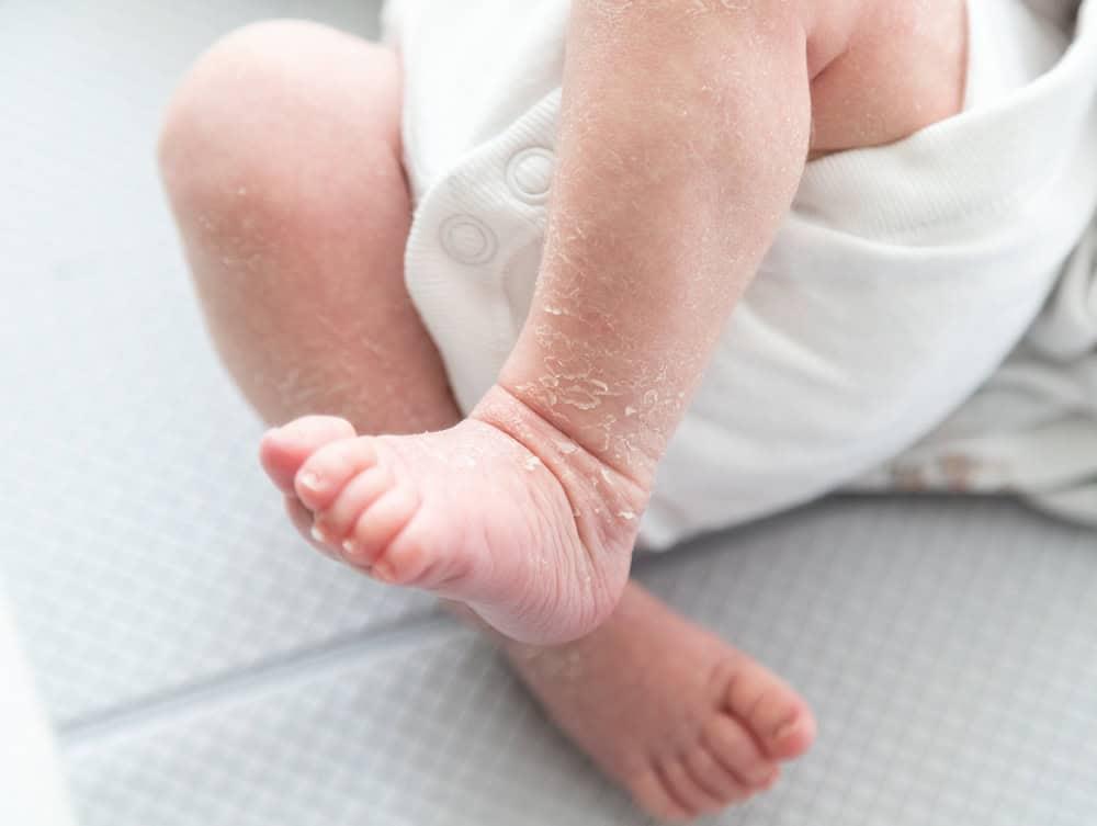 trẻ sơ sinh bị khô da