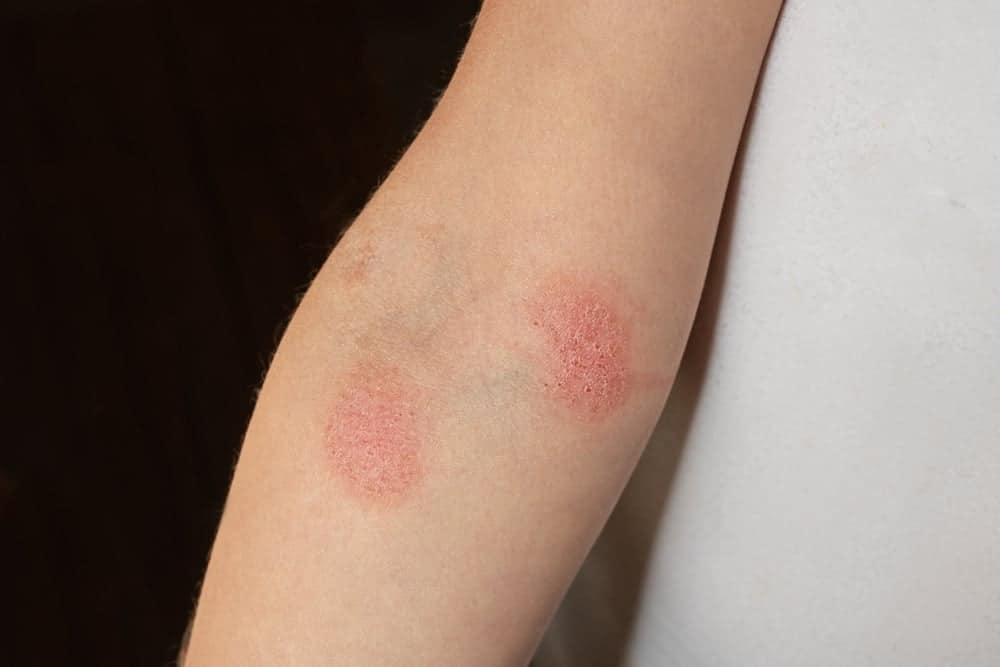 trẻ bị bệnh nấm da