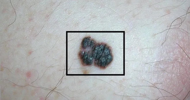 hình ảnh khối u ác tính trên da