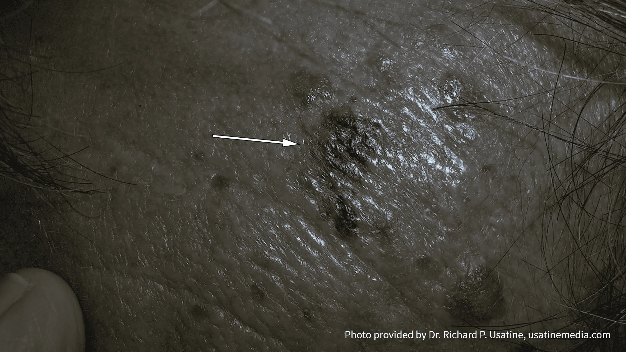 hình ảnh khối u da ác tính 4