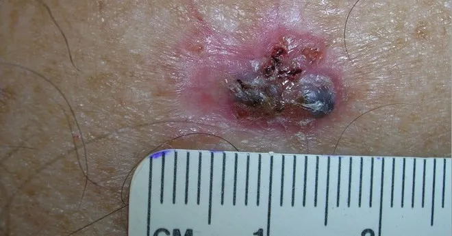 hình ảnh ung thư biểu mô tế bào đáy 3