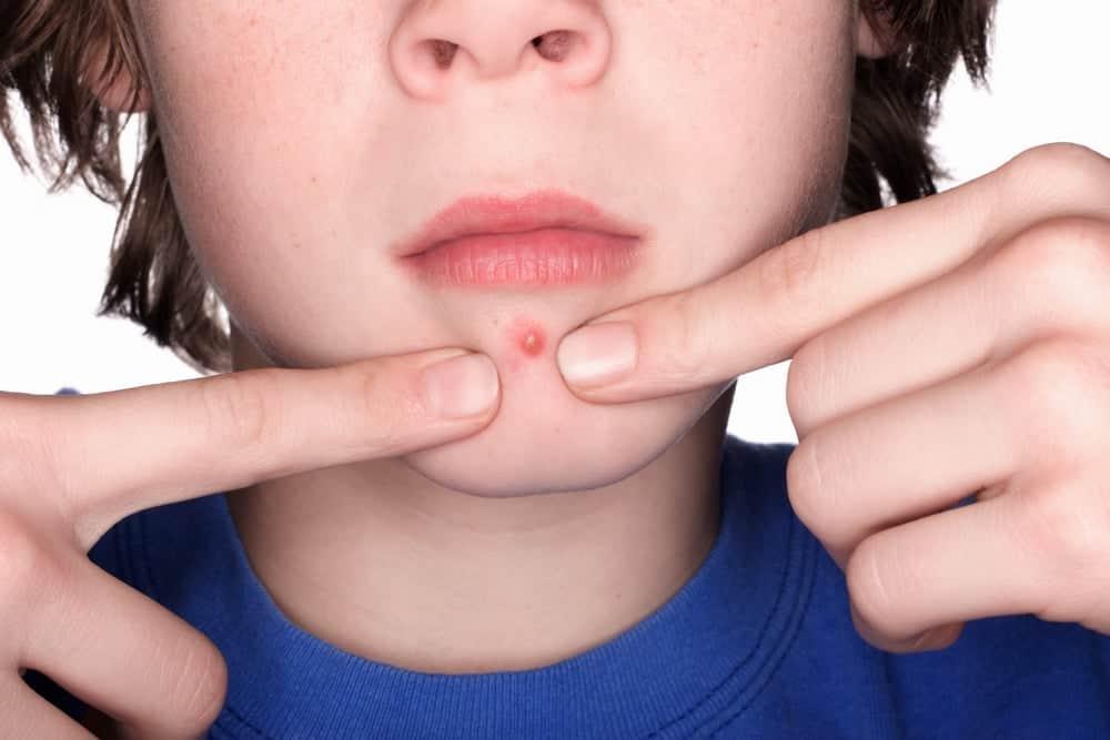 Mụn tuổi dậy thì kéo dài bao lâu