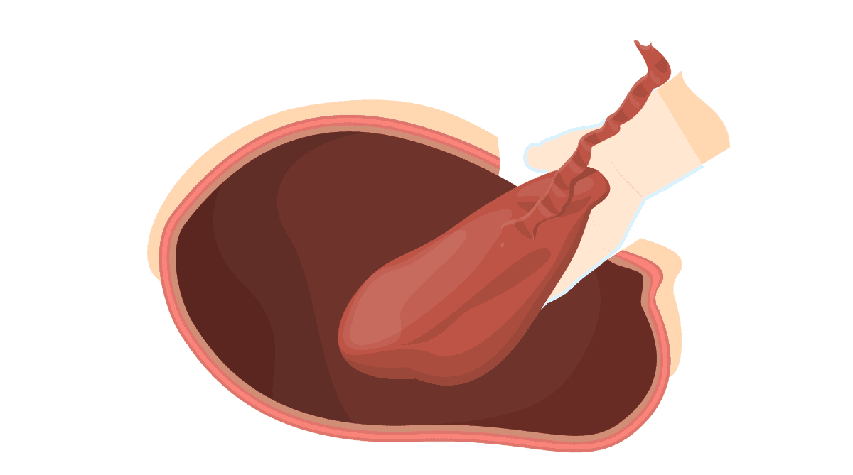 điều trị sót nhau thai sau sinh