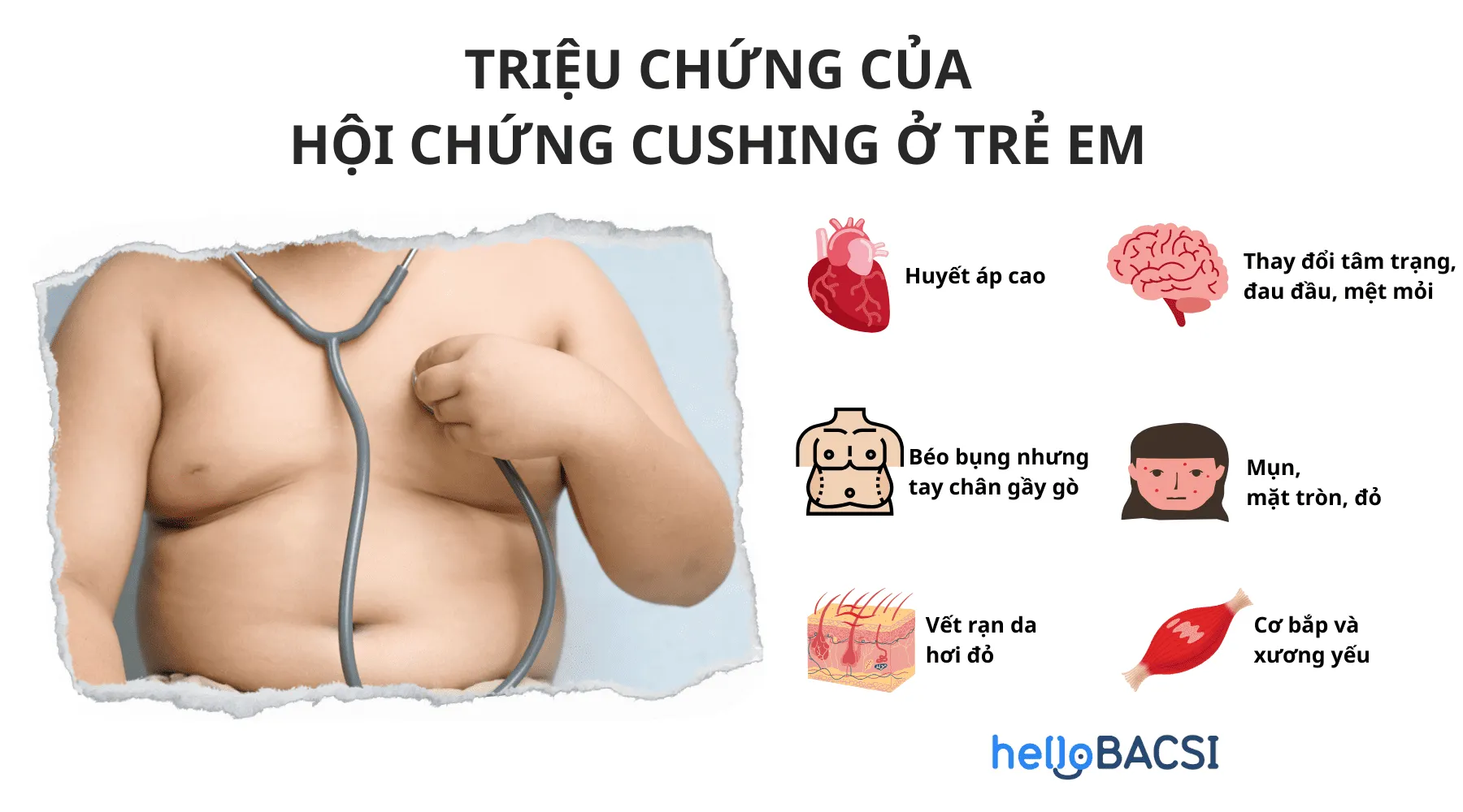 Triệu chứng hội chứng Cushing ở trẻ em