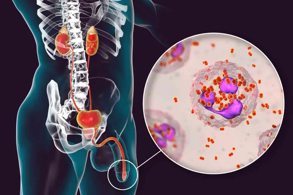 bệnh lậu có nguy hiểm không