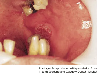 Hình ảnh ung thư miện với vết loét đỏ lốm đốm trên niêm mạc má