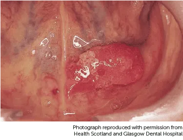 Hình ảnh ở sàn miệng