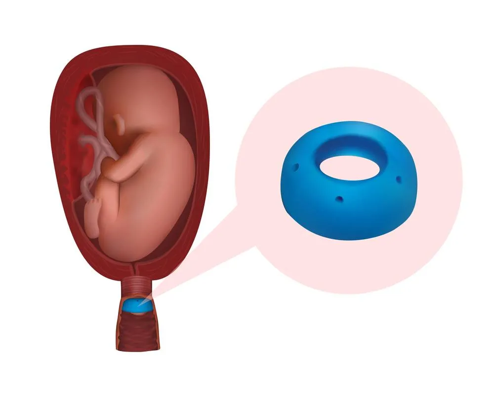 Lưu ý sau khi đặt vòng nâng cổ tử cung