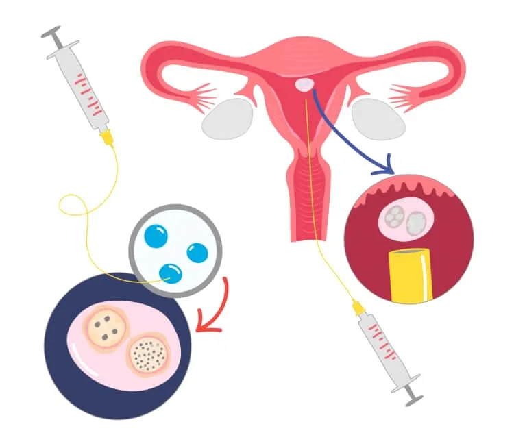 sau khi chọc hút trứng bao lâu thì chuyển phôi