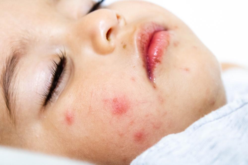 giật mình tay chân miệng