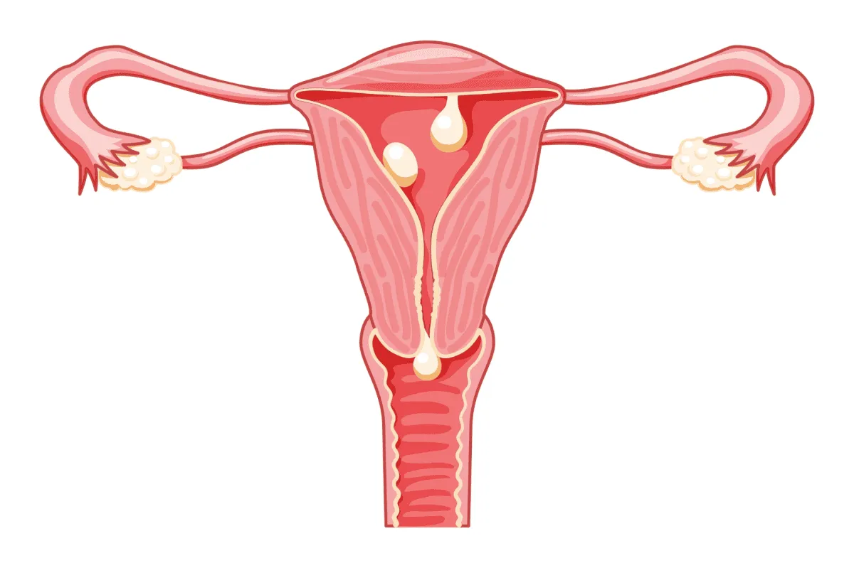 Phụ nữ sau quan hệ ra máu có phải mang thai không? Do polyp tử cung