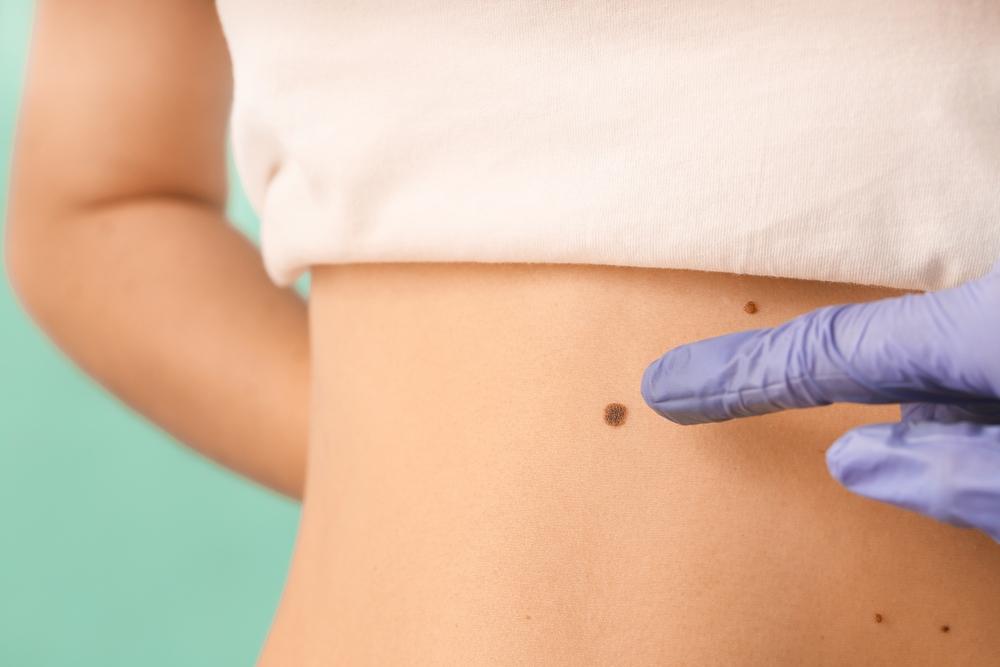 dấu hiệu ung thư da giai đoạn đầu và khi nào nên đi khám