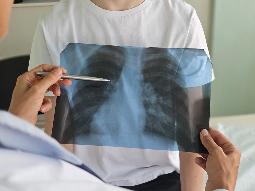 Triệu chứng viêm phổi ở trẻ nhỏ