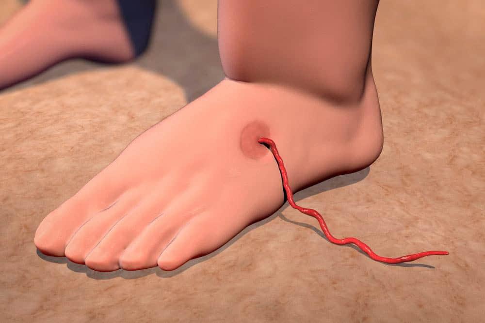 dấu hiệu bệnh giun rồng