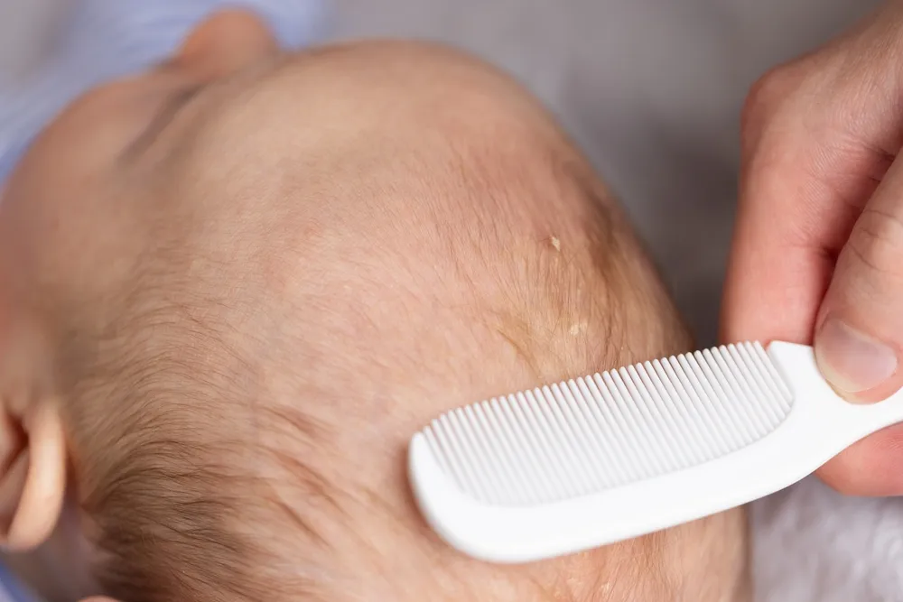 da đầu trẻ sơ sinh có vảy trắng