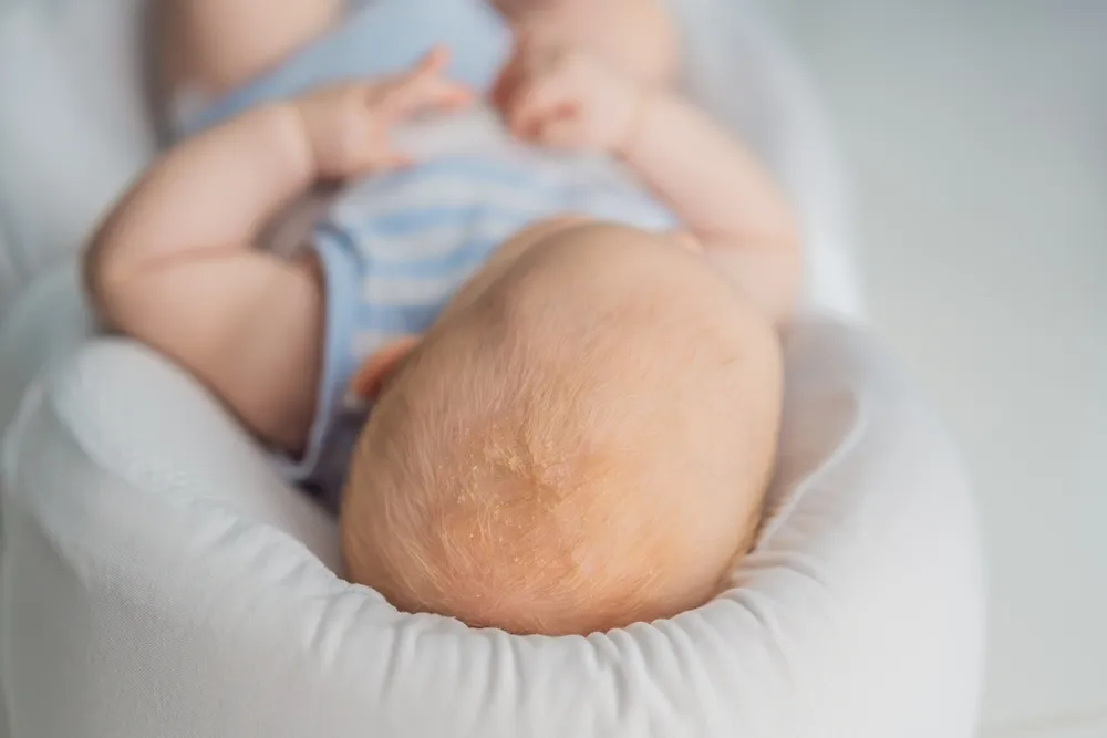 da đầu trẻ sơ sinh có vảy trắng