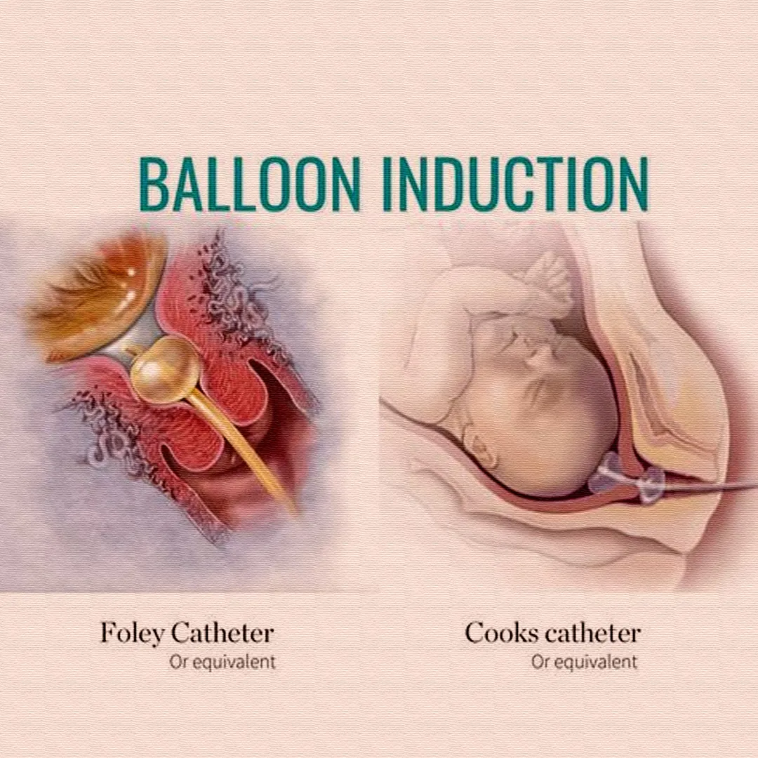 Quy trình đặt bóng kích đẻ