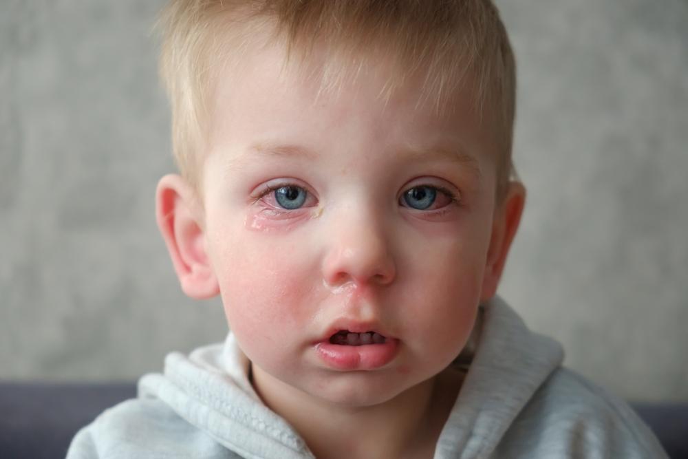 Trẻ bị đau mắt đỏ có những triệu chứng nào?