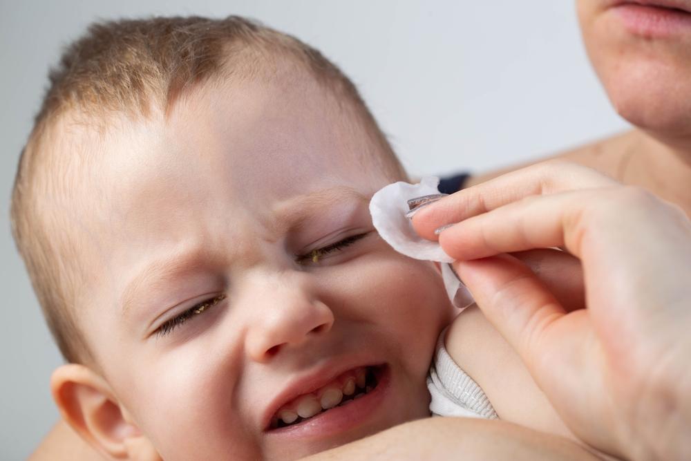 bệnh đau mắt đỏ ở trẻ em 