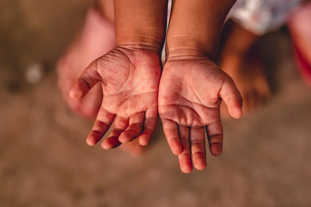 nhiễm virus Enterovirus 71 trải qua những giai đoạn nào