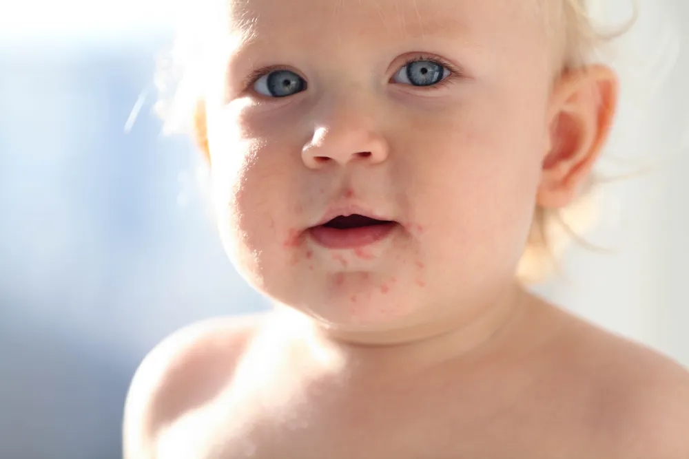 ev71 nguy hiểm thế nào