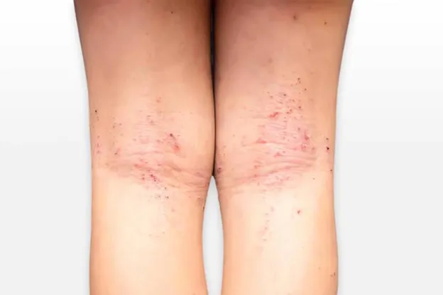 Hình ảnh bệnh tay chân miệng ở người lớn