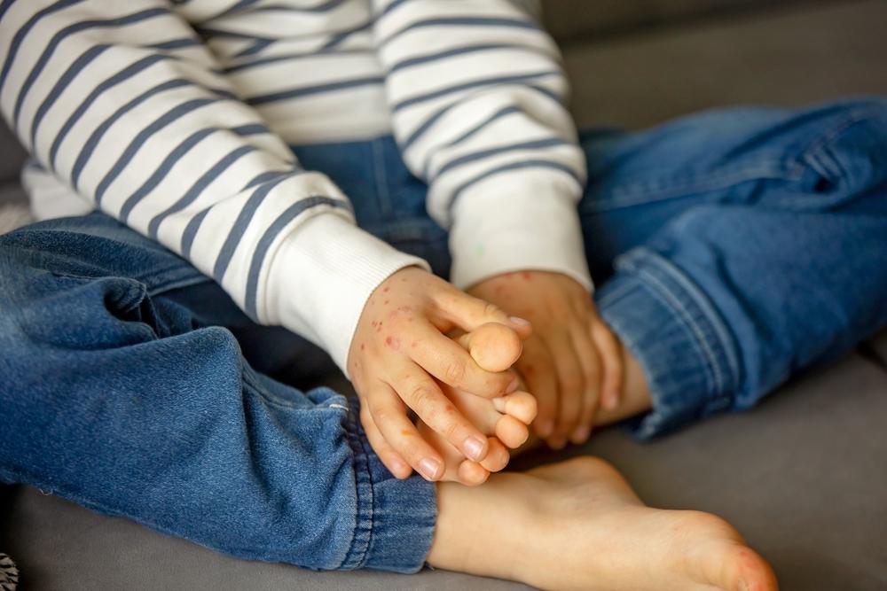 Triệu chứng tay chân miệng